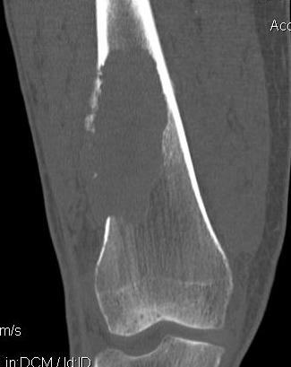 Metastasis Distal Femur CT